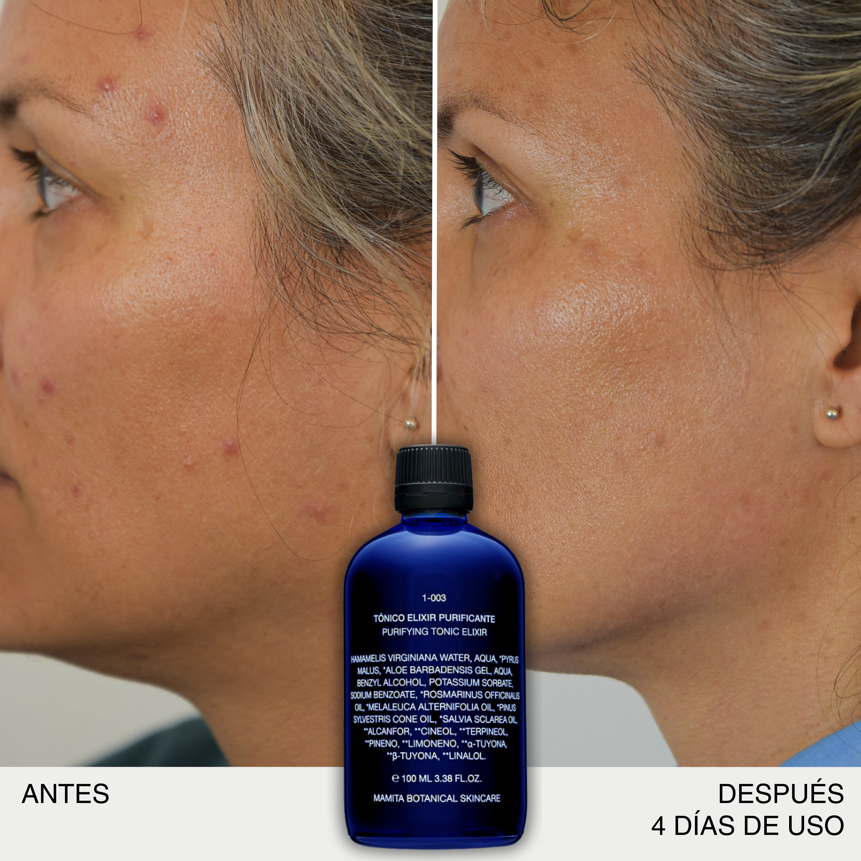 PRO-AGING GRASA/ACNÉ