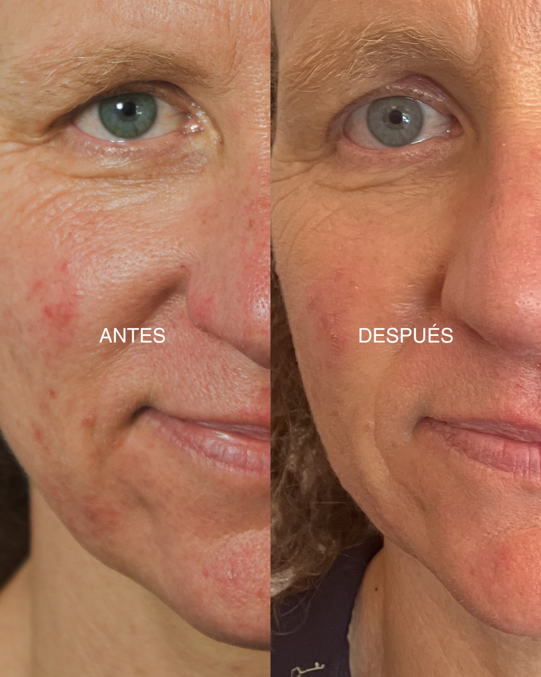 SENSITIVE/ PUSTULAE