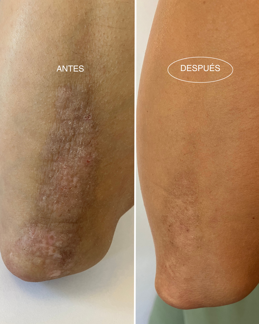 PSORIASIS/ PIEL ATÓPICA