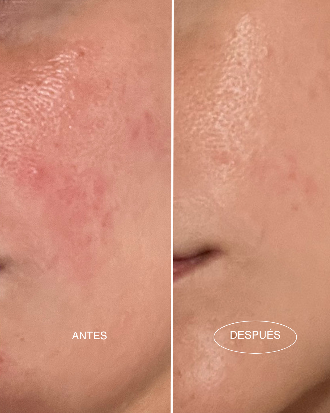 crema-super-linda-antes-despues-piel-sensible-mamita-botanical