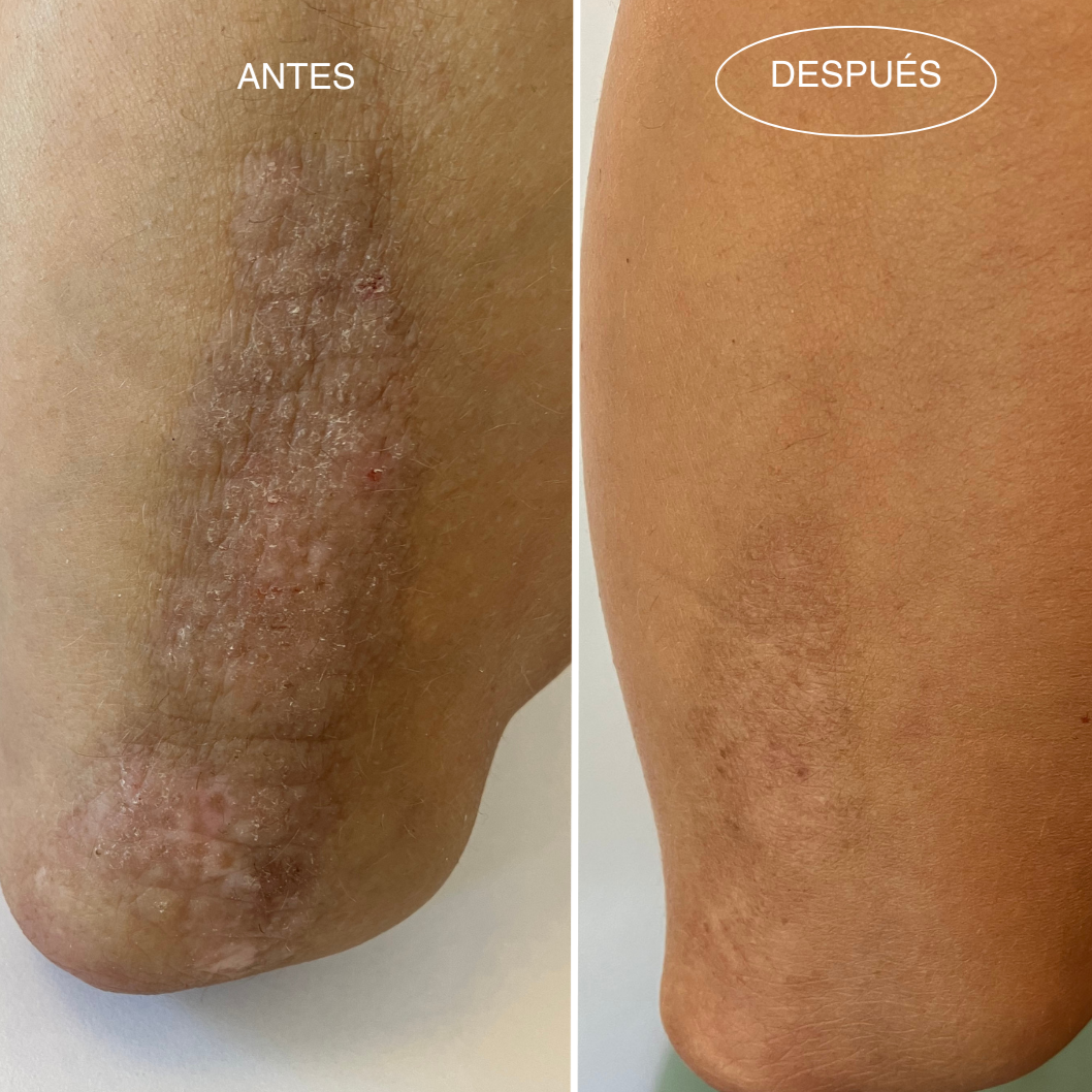 psoriasis-2-antes-despues-aceite-revitalizante-piel-sensible-mamita-botanical