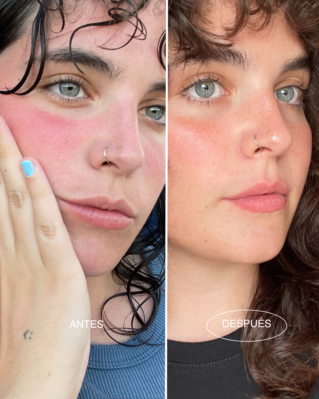 rosacea-piel-sensible-mamita-botanical