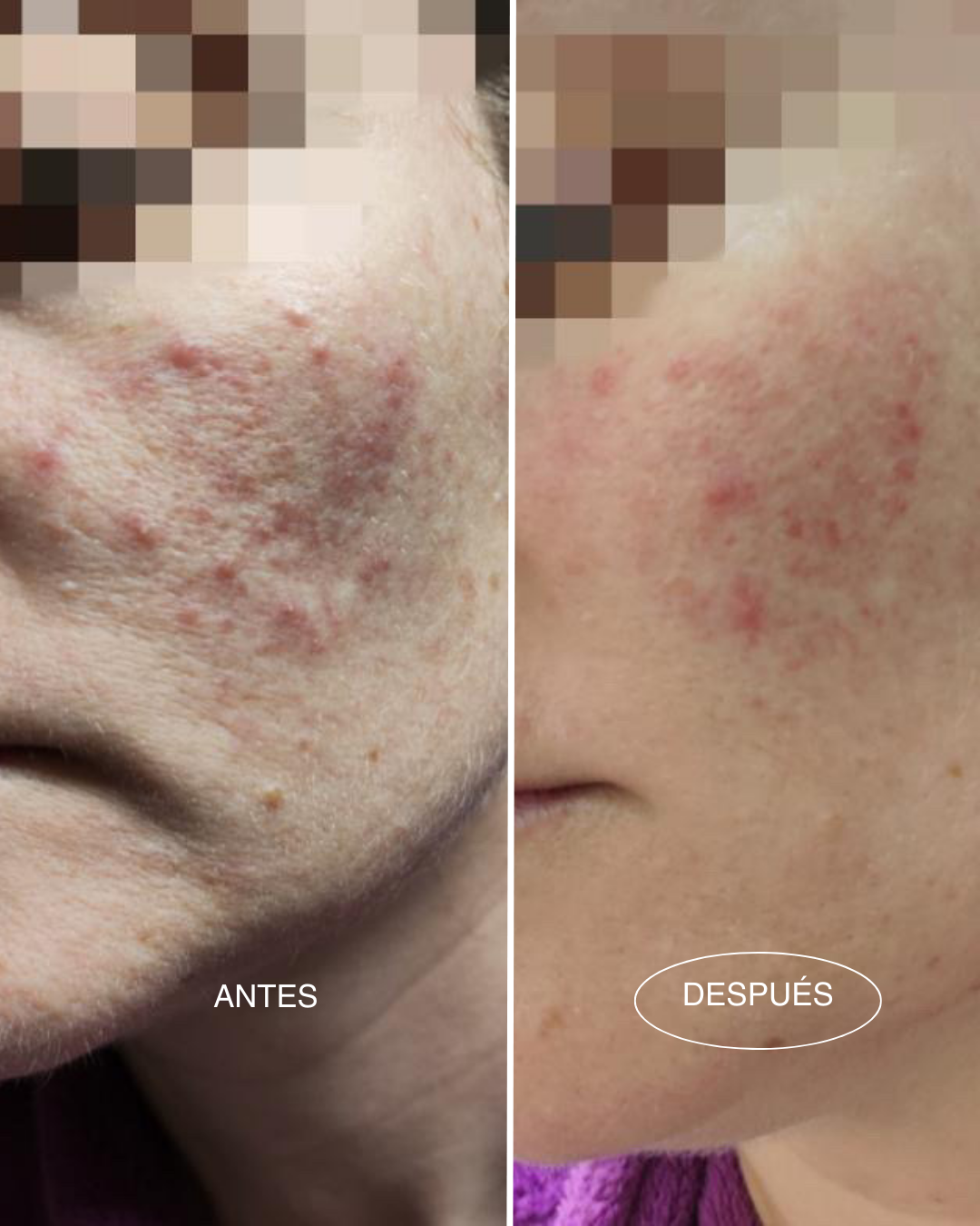 tonico-calma-antes-despues-piel-sensible-mamita-botanical