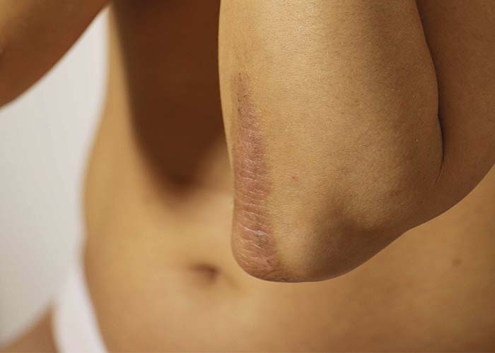 CÓMO TRATAR LA PSORIASIS