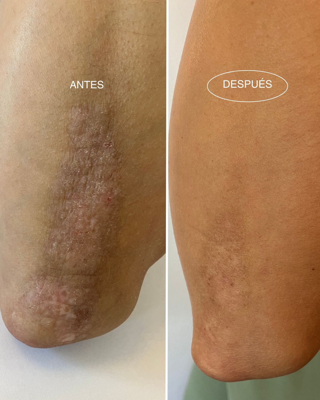 psoriasis-antes-despues-aceite-revitalizante-piel-sensible-mamita-botanical