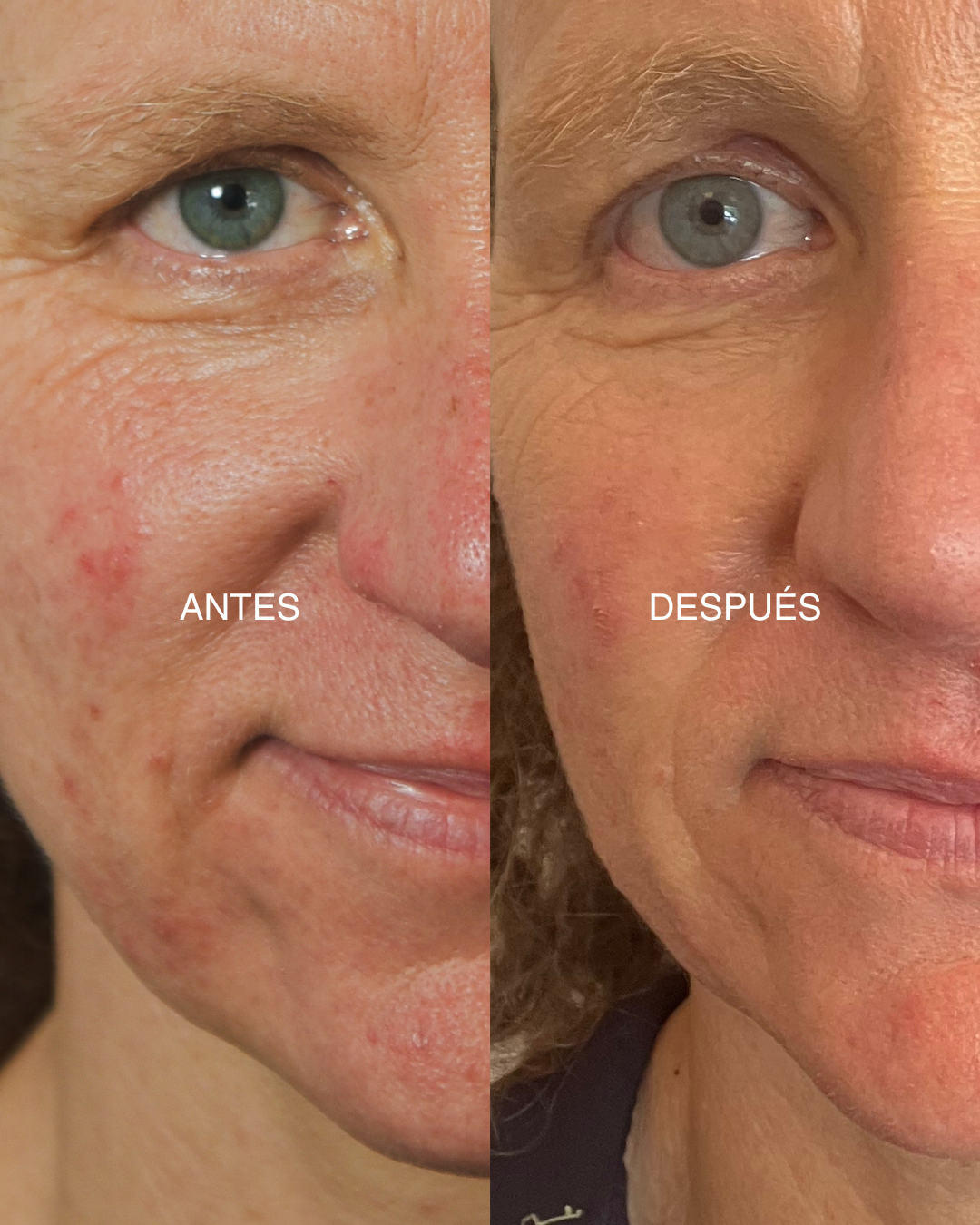 serum-pro-resistencia-antes-despues-piel-sensible-mamita-botanical