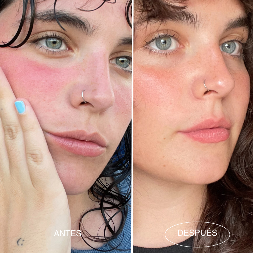 serum-super-linda-antes-despues-piel-sensible-mamita-botanical